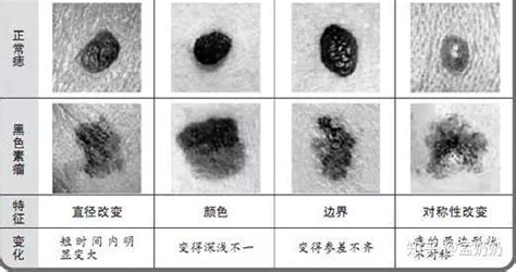 黑痣凸起|这样的黑痣竟是“黑色素瘤”！医生：超过这个尺寸的黑。